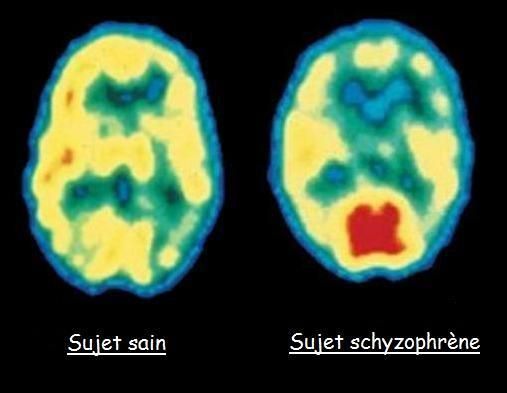 schizophrenie et son expression humaine