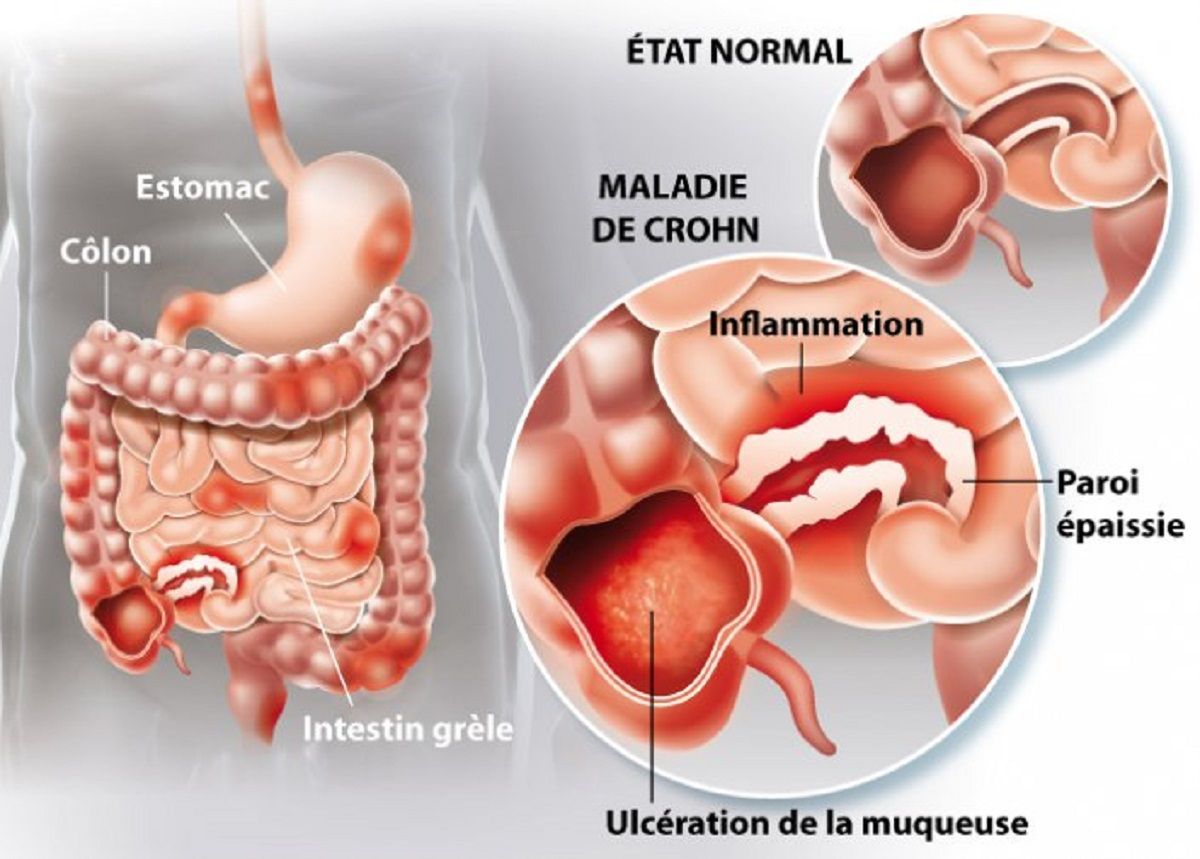 Dessin sur quest la Maladie de Crohn