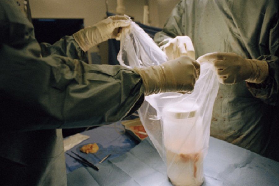 Tranfert d un organe dans le cadre d une greffe