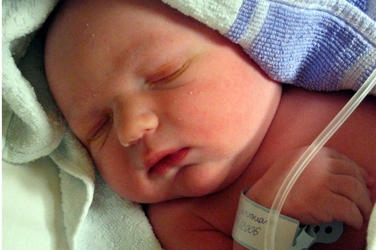 Un Nouveau ne 10 minutes apres la naissance. Identifie avec une agenesie du bras droit