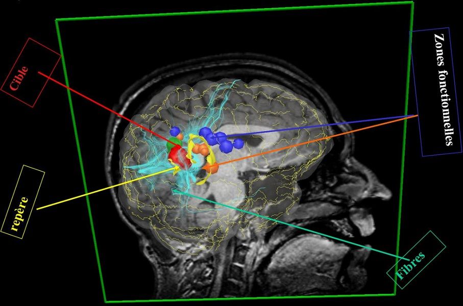 Imagerie médicale du cerveau photo Inserm