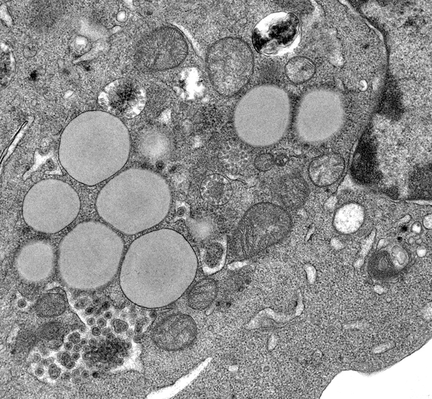 Cellule du foie infecte par l hepatite C